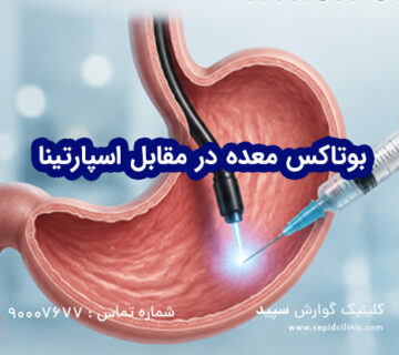 بوتاکس معده در مقابل اسپارتینا