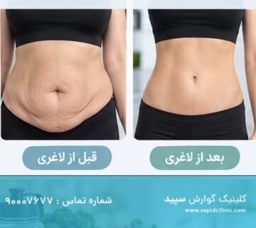 چگونه بعد از لاغری با اسپارتینا از افتادگی پوست جلوگیری کنیم؟