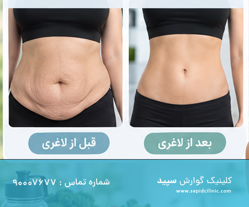 چگونه بعد از لاغری با اسپارتینا از افتادگی پوست جلوگیری کنیم؟