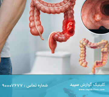 خونریزی رکتال و سرطان کولون