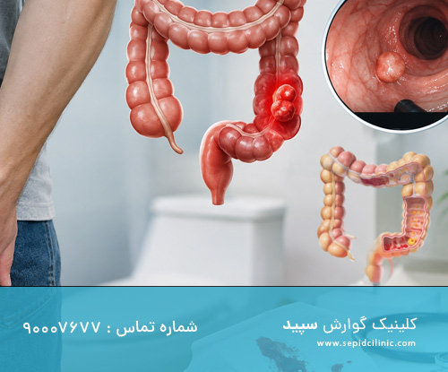 خونریزی رکتال و سرطان کولون