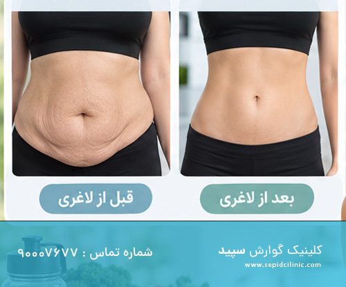چگونه بعد از لاغری با اسپارتینا از افتادگی پوست جلوگیری کنیم؟