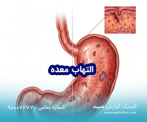 تشخیص و درمان التهاب معده