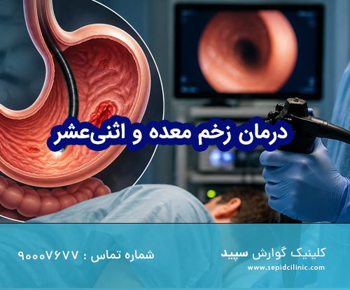 درمان زخم معده و اثنی‌عشر با آندوسکوپی